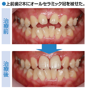 No.76 オールセラミック冠について | ふかつ歯科・矯正歯科 広島県福山